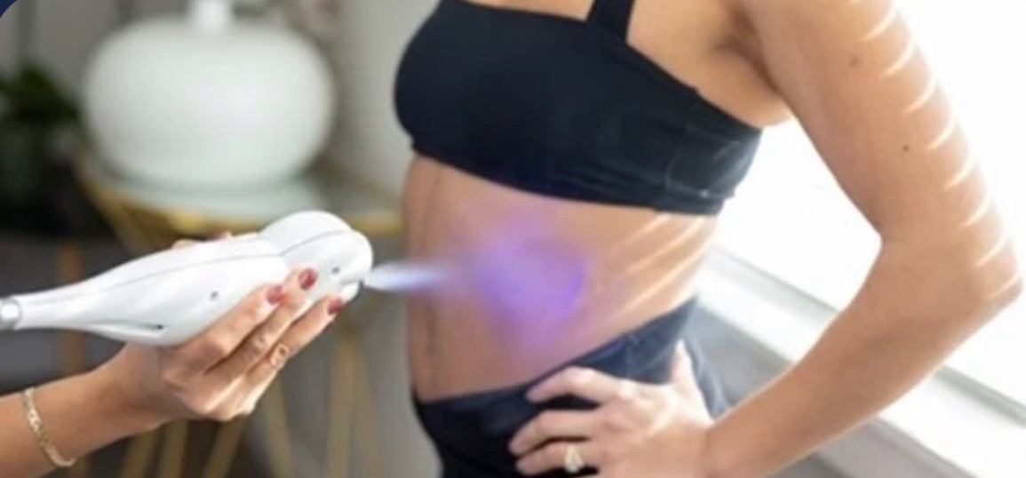 Cryo slimming device applying cold vapor to a client's abdomen