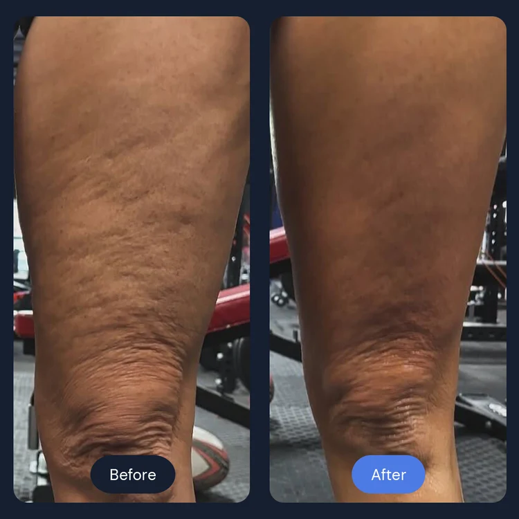 Before and after skin tightening on the back of the thigh