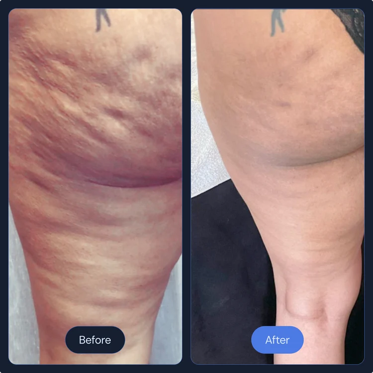 Before and after cellulite and skin texture treatment on the thigh
