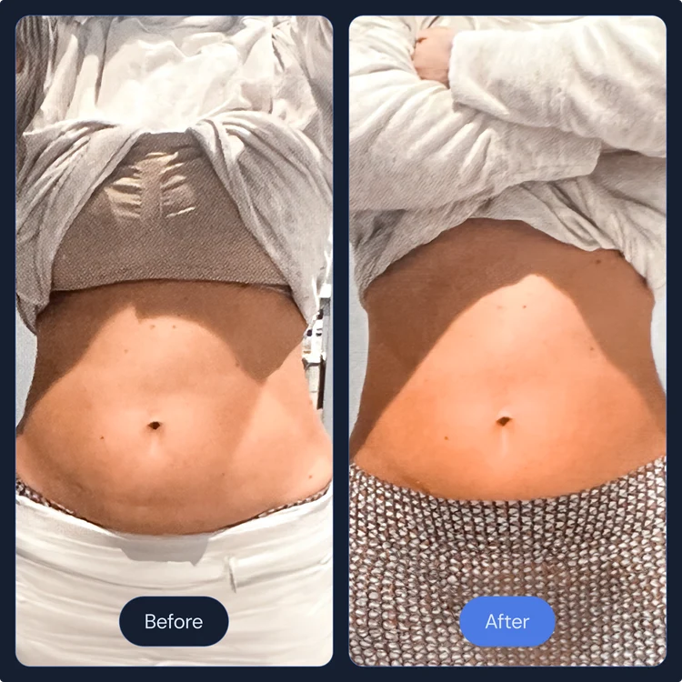 Before and after cryo slimming on the abdomen
