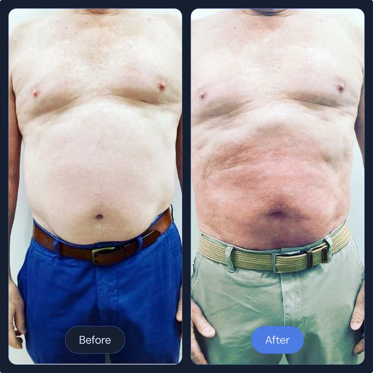 Before and after cryo slimming on the midsection