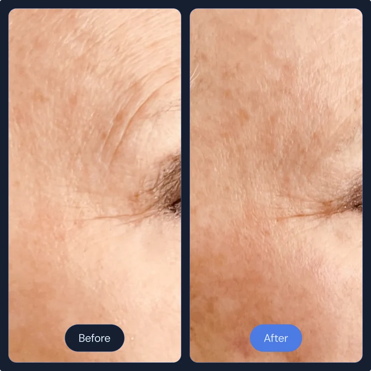 Before and after fine line reduction around the eye