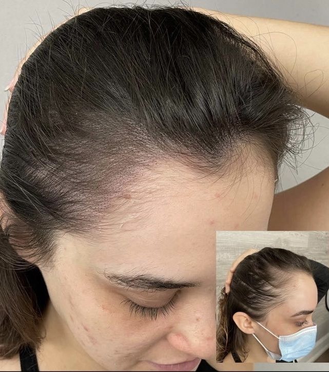 Hairline and part line showing added density after scalp micropigmentation