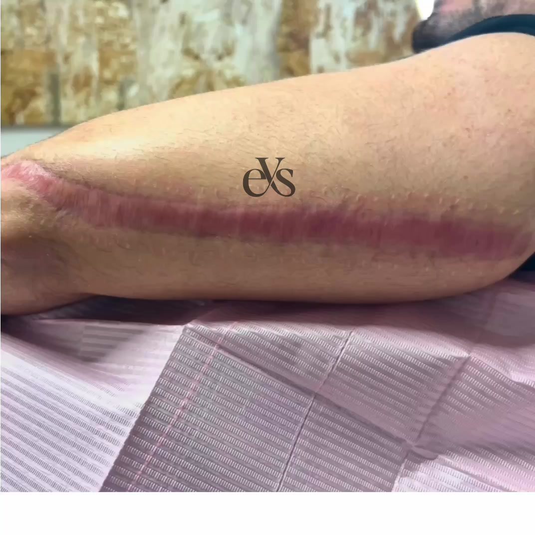 Healed forearm scar blended with surrounding skin tone after camouflage work