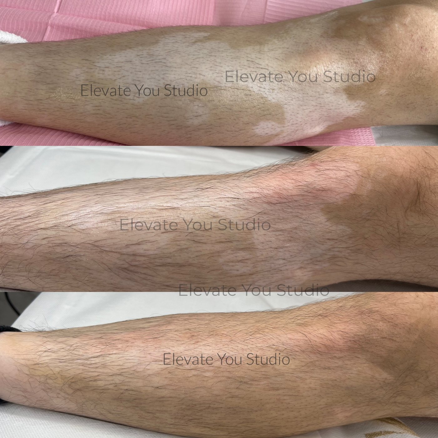 Legs with vitiligo patches shown before and after camouflage pigment work